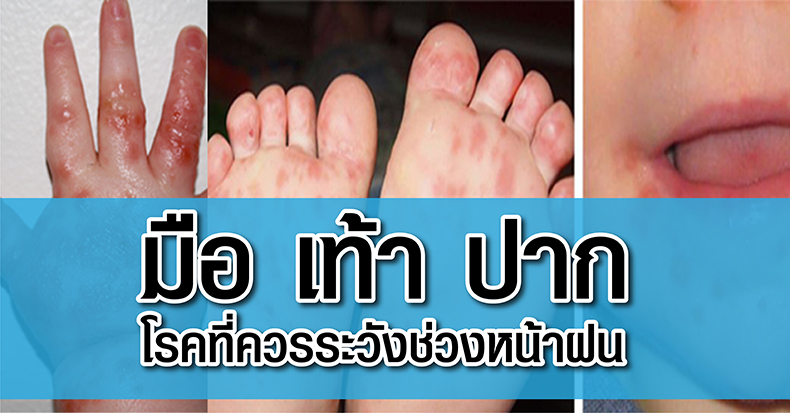 มือ เท้า ปาก โรคที่ควรระวังช่วงหน้าฝน 