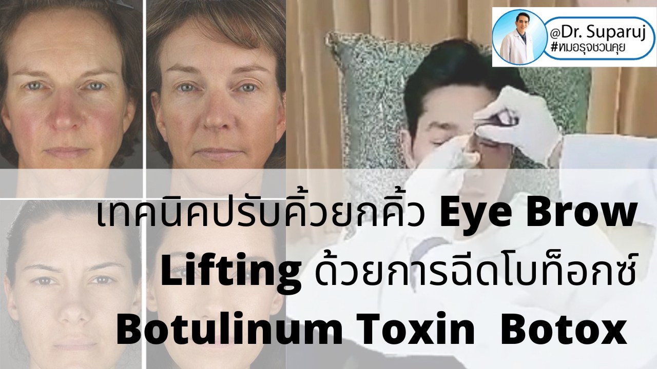 เทคนิคปรับคิ้วยกคิ้ว Eye Brow Lifting ด้วยการฉีดโบท็อกซ์ Botulinum Toxin Botox