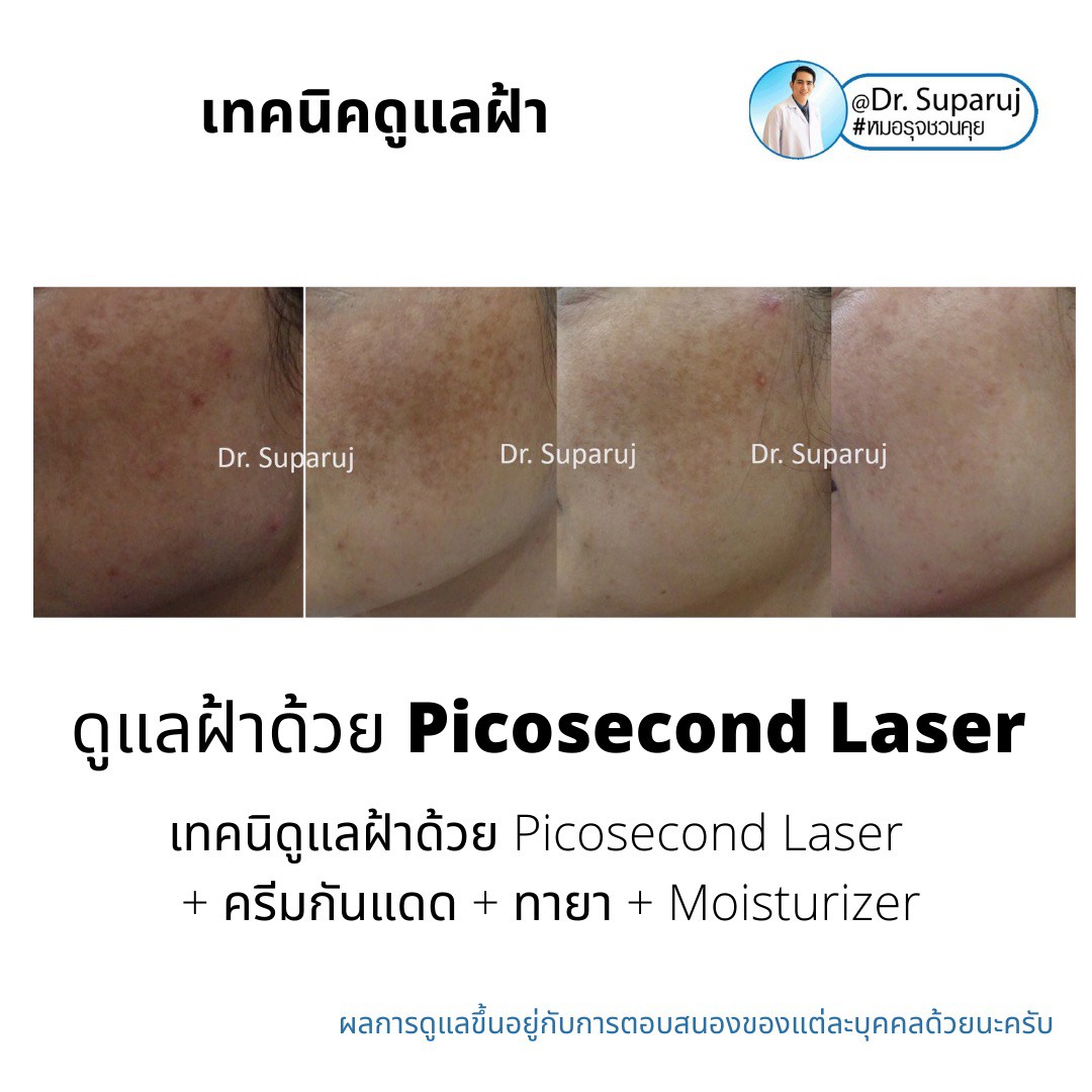 Picosecond Laser เทคโนโลยีพลังงานสูงในช่วงระยะเวลาที่สั้นมากช่วยทำลายเม็ดสีได้อย่างมีประสิทธิภาพ โดยส่งผลต่อเนื้อเยื่อข้างเคียงน้อยมาก
