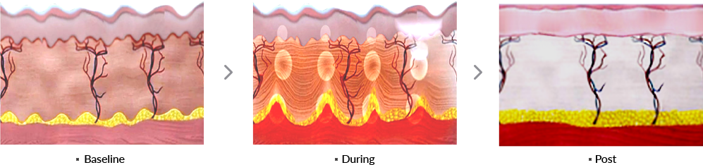 แนะนำเทคนิคดูแล ยกกระชับผิว: Ultraformer III นวัตกรรมคลื่นเสียงยกกระชับ ลดริ้วรอย กระชับผิว ดูแลหลุมสิวโดยไม่ต้องผ่าตัด แนะนำเทคนิคดูแล ยกกระชับผิว: Ultraformer III นวัตกรรมคลื่นเสียงยกกระชับ ลดริ้วรอย กระชับผิว ดูแลหลุมสิวโดยไม่ต้องผ่าตัด