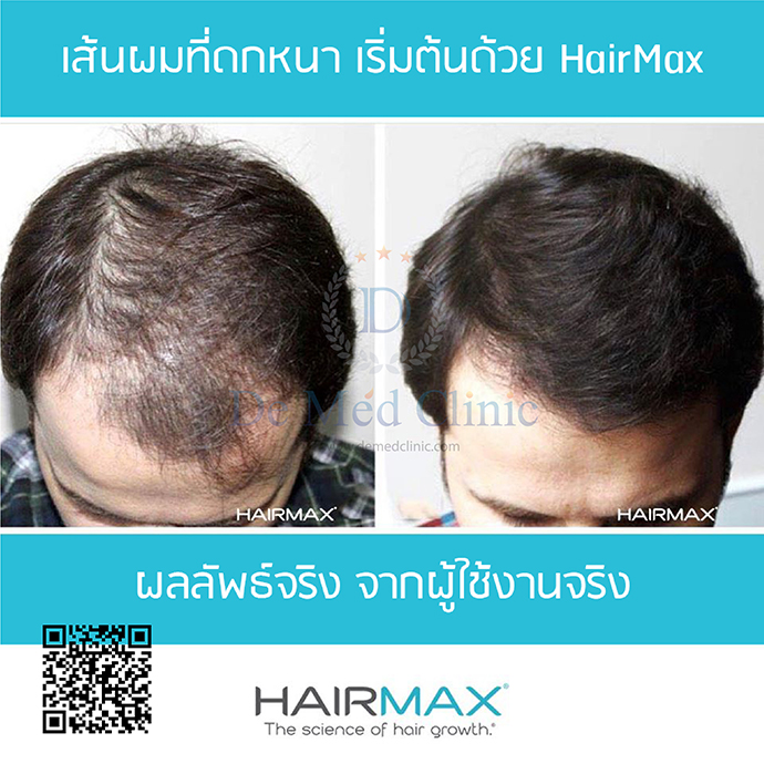 HairMax LaserBand 82แบบที่ผมคาดผม 84 เลเซอร์   ราคา ปกติ 49,900  บาท พิเศษราคา 46,900  บาท  ใช้เวลาในรักษาที่รวดเร็ว เพียงแค่ 90 วินาทีต่อครั้ง 3 ครั้งต่อสัปดาห์