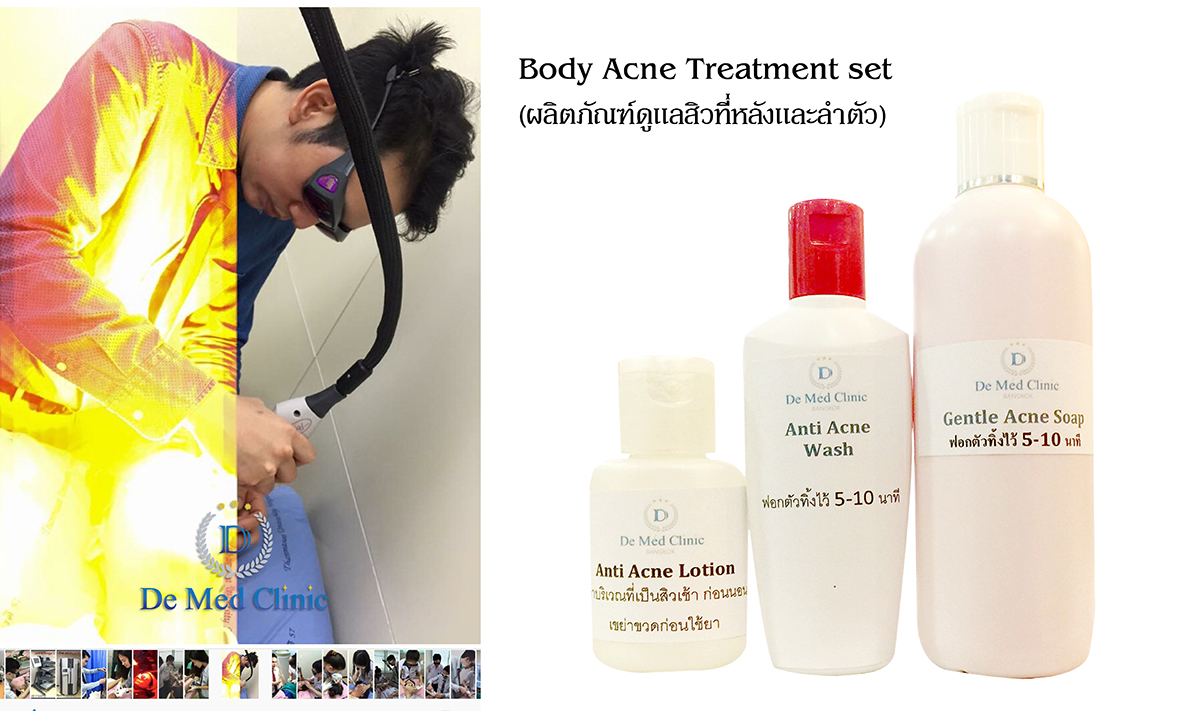 Body Acne Treatment Program by De Med Clinic โปรแกรมดูแลรักษาสิวที่ชำ