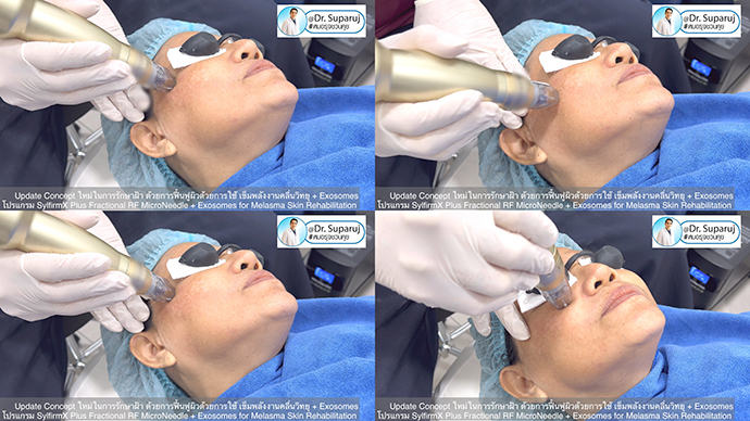 แนะนำเทคนิครักษาหลุมสิวด้วยโปรแกรม SYLFIRM X Plus Fractional RF Microneedle: มีลักษณะพลังงาน Pulsed Wave PW Mode + Continous Wave CW Mode แนะนำเทคนิครักษาหลุมสิวด้วยโปรแกรม SYLFIRM X Plus Fractional RF Microneedle: มีลักษณะพลังงาน Pulsed Wave PW Mode + Continous Wave CW Mode