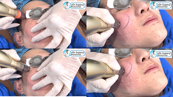 แนะนำเทคนิครักษาหลุมสิวด้วยโปรแกรม SYLFIRM X Plus Fractional RF Microneedle: มีลักษณะพลังงาน Pulsed Wave PW Mode + Continous Wave CW Mode แนะนำเทคนิครักษาหลุมสิวด้วยโปรแกรม SYLFIRM X Plus Fractional RF Microneedle: มีลักษณะพลังงาน Pulsed Wave PW Mode + Continous Wave CW Mode