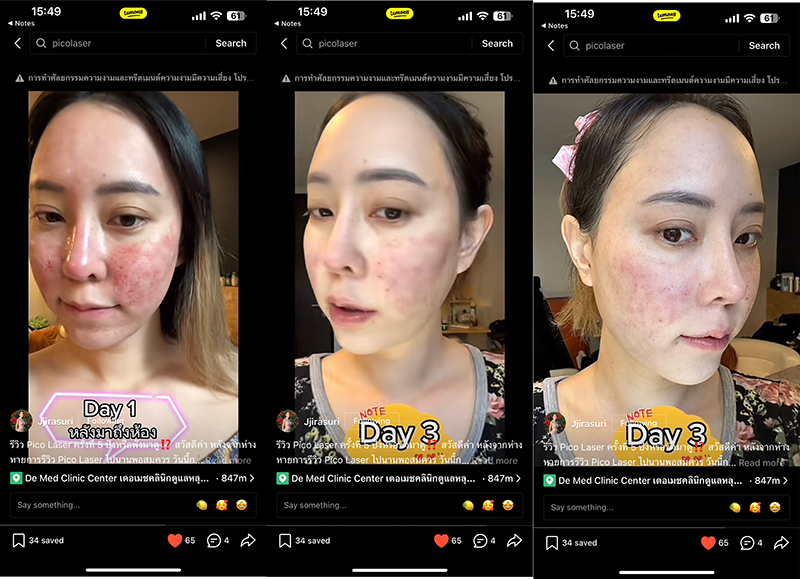 รีวิว Pico Laser รักษาหลุมสิวครั้งที่ 5 ปังหรือพังมาดู !? รีวิว Pico Laser รักษาหลุมสิวครั้งที่ 5 ปังหรือพังมาดู !?