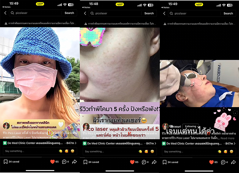 รีวิว Pico Laser รักษาหลุมสิวครั้งที่ 5 ปังหรือพังมาดู !? รีวิว Pico Laser รักษาหลุมสิวครั้งที่ 5 ปังหรือพังมาดู !?