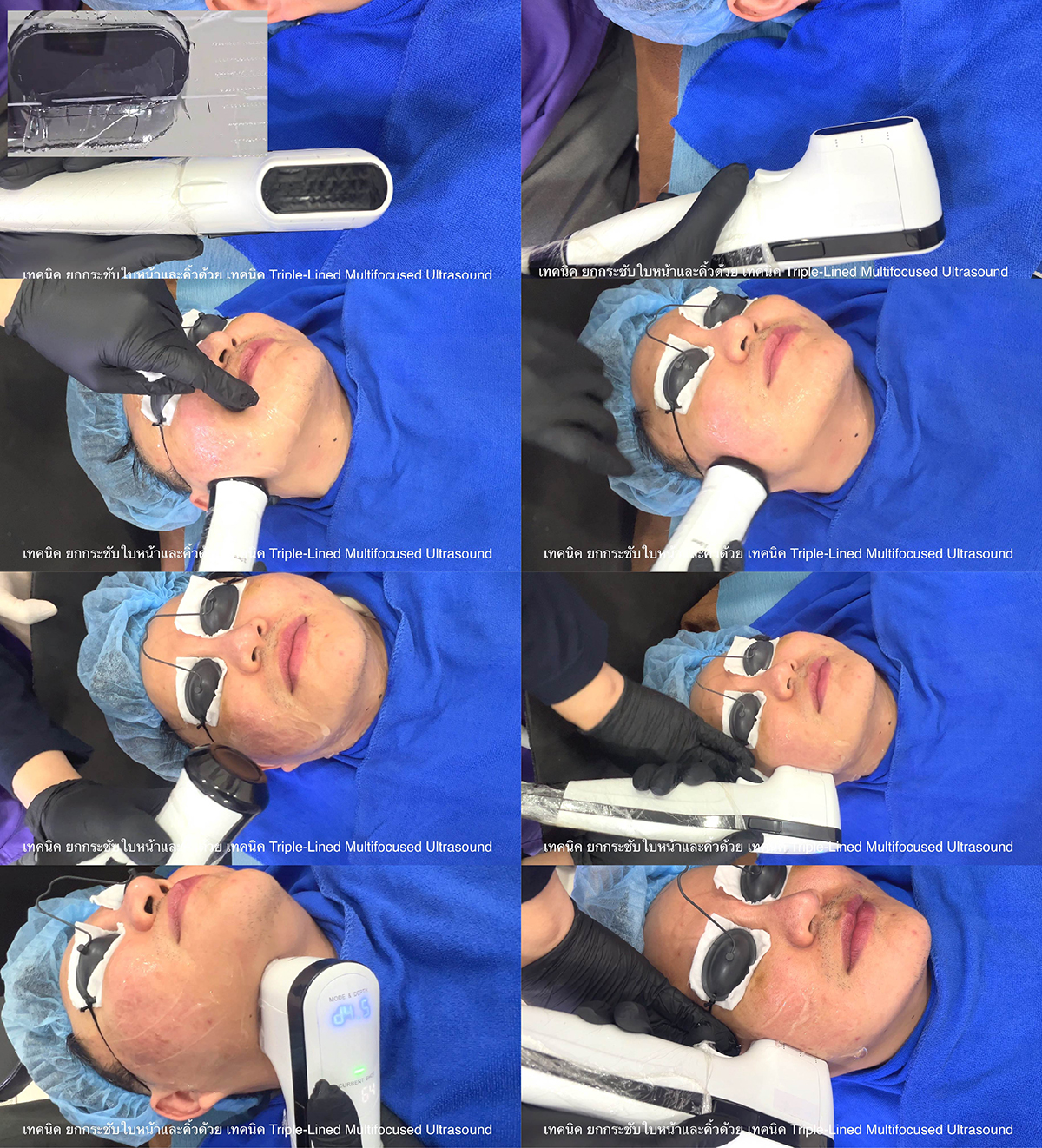 เทคนิค ยกกระชับใบหน้าและคิ้วด้วย เทคนิค Triple-Lined Multifocused Ultrasound เทคนิค ยกกระชับใบหน้าและคิ้วด้วย เทคนิค Triple-Lined Multifocused Ultrasound