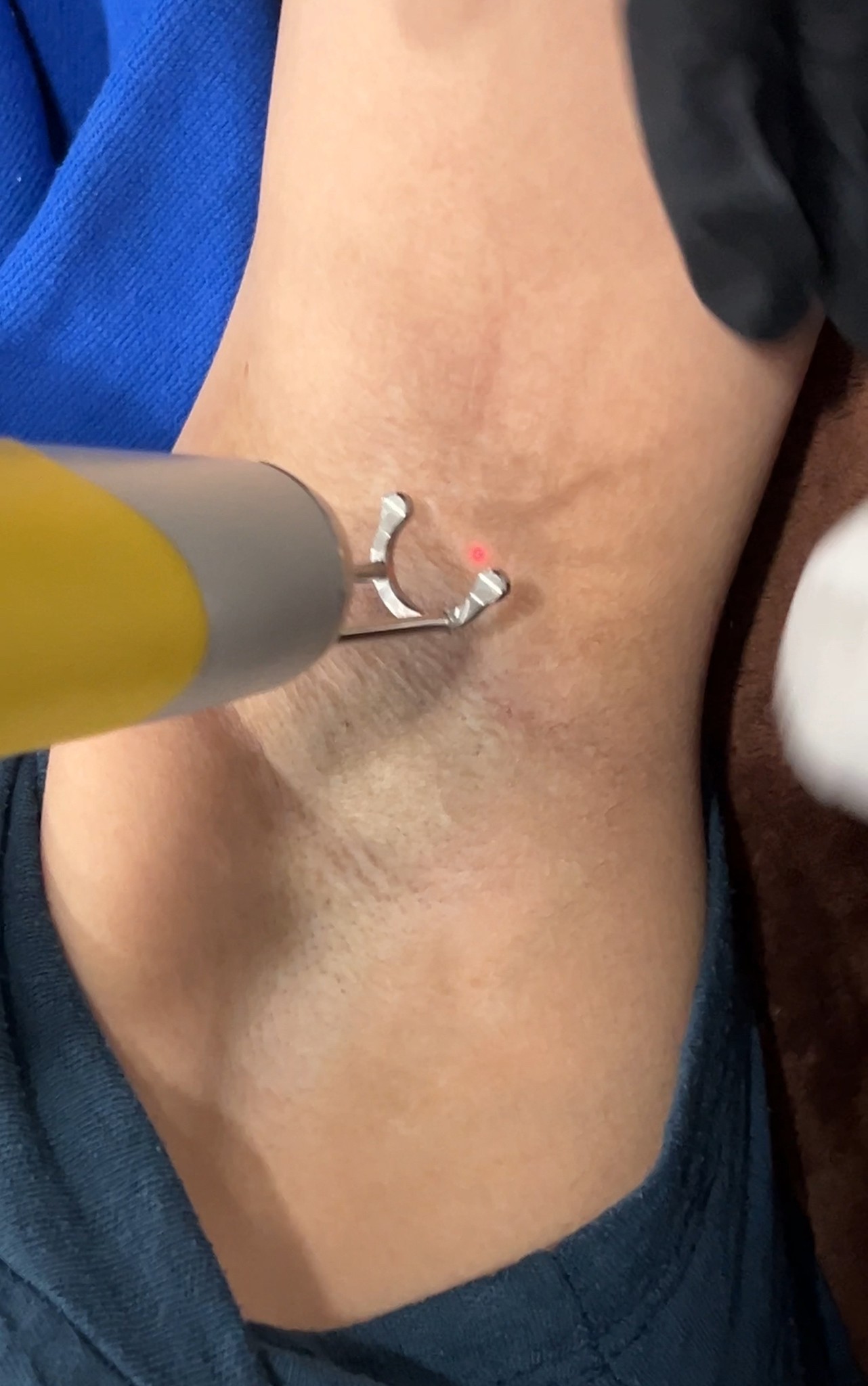 รักแร้ดำเกิดจากสาเหตุอะไร & ดูแลอย่างไร ? รักแร้ดำเกิดจากสาเหตุอะไร & ดูแลอย่างไร ?