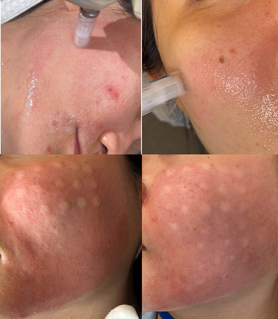 เทคนิคการใช้ Botulinum Toxin และ Microneedling ในการดูแลปัญหารูขุมขนกว้าง สิว และการฟื้นฟูคุณภาพผิว เทคนิคการใช้ Botulinum Toxin และ Microneedling ในการดูแลปัญหารูขุมขนกว้าง สิว และการฟื้นฟูคุณภาพผิว