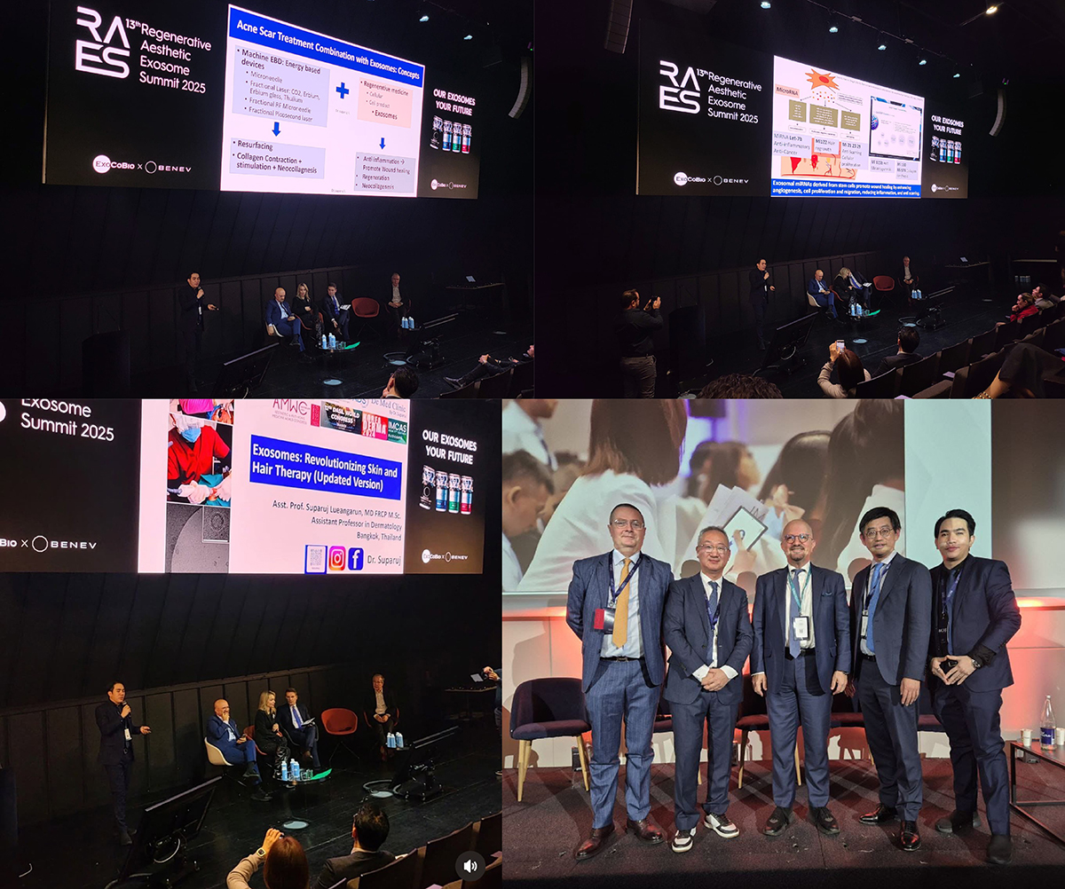 ผศ. นพ. ศุภะรุจ เลื่องอรุณ (หมอรุจ) ได้รับเกียรติเชิญเป็นวิทยากรบรรยายเทคนิคในการดูแลปัญหาผิว หลุมสิว แผลเป็น ผมร่วงผมบาง ให้งานประชุมวิชาการนานาชาติ RAES (Regenerative Aesthetic Exosome Summit) ที่กรุงปารีสประเทศฝรั่งเศสซึ่งการจัดจัดงานครั้งแรกในกลุ่มประเทศในโซนยูโรครับ ผศ. นพ. ศุภะรุจ เลื่องอรุณ (หมอรุจ) ได้รับเกียรติเชิญเป็นวิทยากรบรรยายเทคนิคในการดูแลปัญหาผิว หลุมสิว แผลเป็น ผมร่วงผมบาง ให้งานประชุมวิชาการนานาชาติ RAES (Regenerative Aesthetic Exosome Summit) ที่กรุงปารีสประเทศฝรั่งเศสซึ่งการจัดจัดงานครั้งแรกในกลุ่มประเทศในโซนยูโรครับ