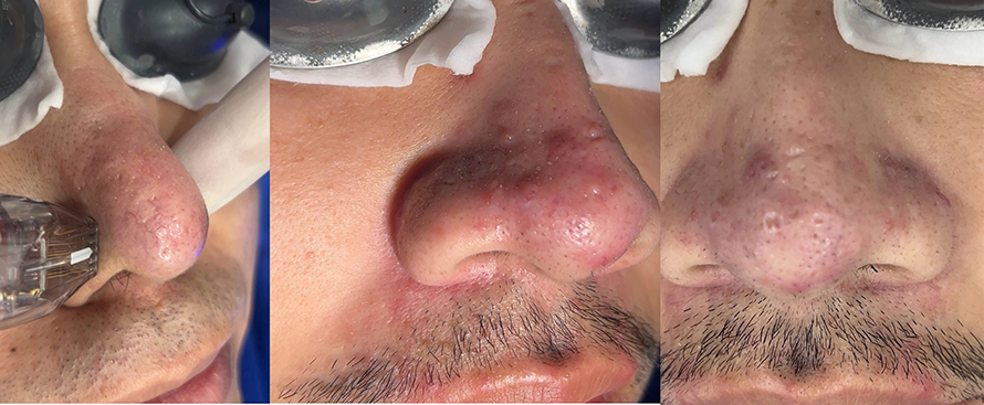 โรคโรซาเชีย Rosacea มีอาการอย่างไร และดูแลรักษาอย่างไร? โรคโรซาเชีย Rosacea มีอาการอย่างไร และดูแลรักษาอย่างไร?