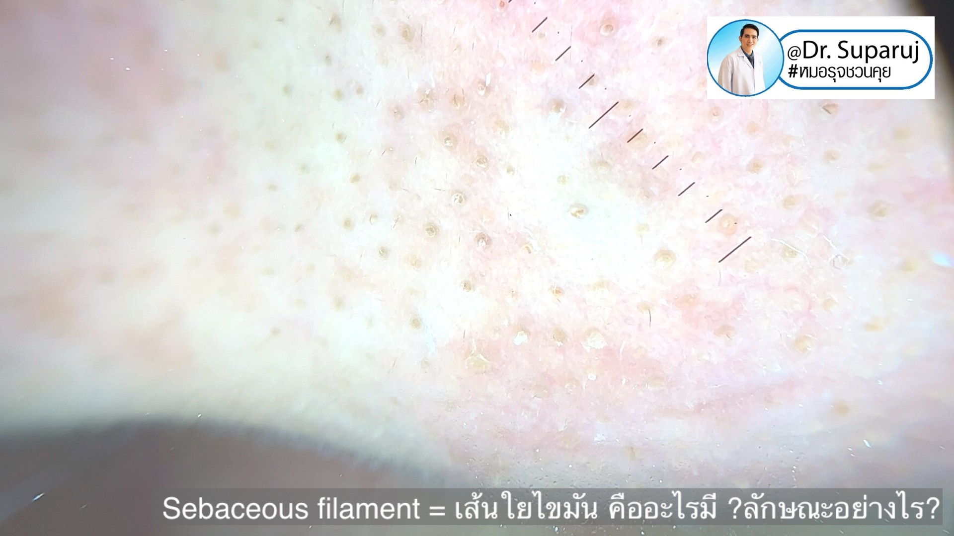 Sebaceous filament = เส้นใยไขมัน คืออะไรมี ?ลักษณะอย่างไร ? ดูแลได้อย่างไร? (คลิปเต็ม Full Clip YouTube Facebook: Dr. Suparuj ครับ