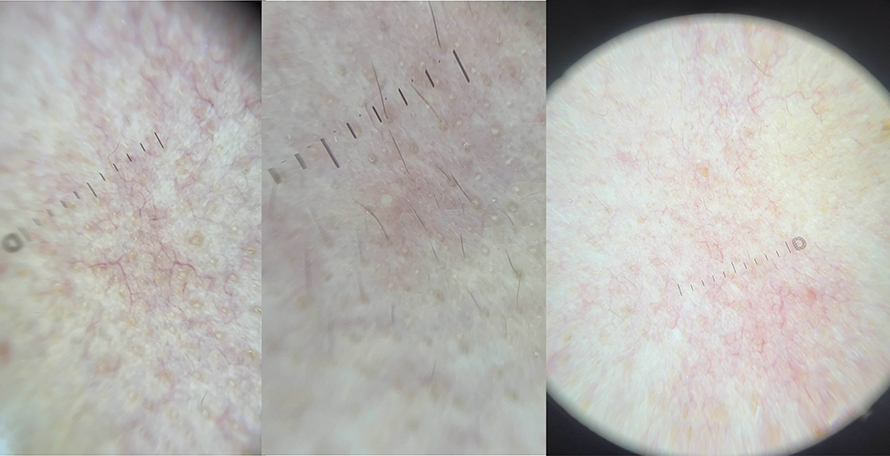 โรคโรซาเชีย Rosacea มีอาการอย่างไร และดูแลรักษาอย่างไร? โรคโรซาเชีย Rosacea มีอาการอย่างไร และดูแลรักษาอย่างไร?