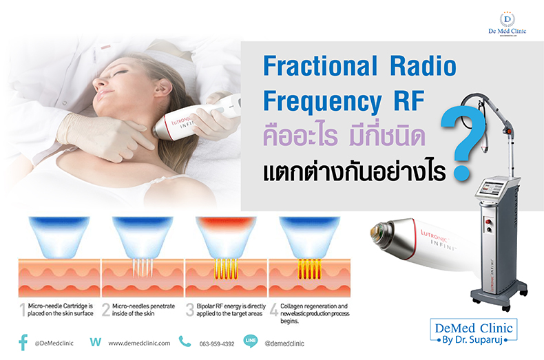 Fractional Radio Frequency RF คืออะไร มีกี่ชนิด แตกต่างกันอย่างไร ?
