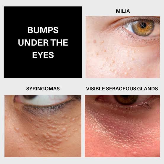 มีตุ่มเล็กๆสีขาวเหลืองหลายๆตุ่มที่เปลือกตาล่างคืออะไร : เป็นต่อมไขมันที่เด่นชัดครับ Prominent sebaceous gland ครับ มีตุ่มเล็กๆสีขาวเหลืองหลายๆตุ่มที่เปลือกตาล่างคืออะไร : เป็นต่อมไขมันที่เด่นชัดครับ Prominent sebaceous gland ครับ