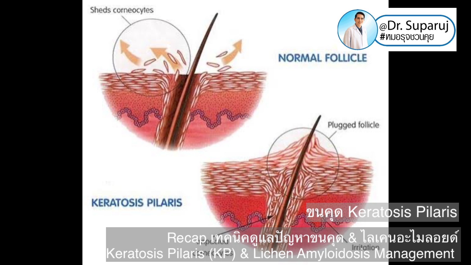 Recap เทคนิคดูแลปัญหาขนคุด & ไลเคนอะไมลอยด์ Keratosis Pilaris (KP) & Lichen Amyloidosis Management