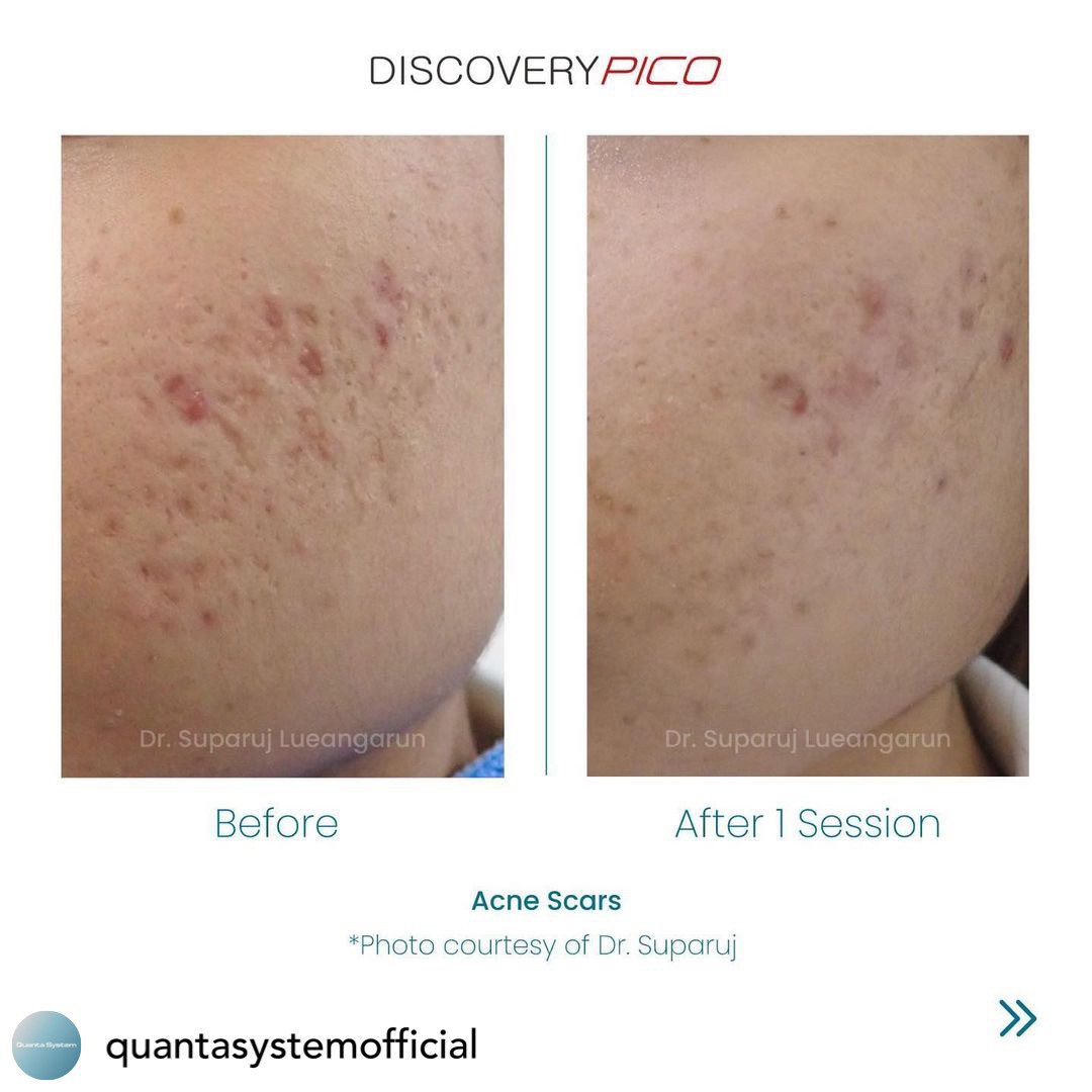 Update Discovery Picosecond Laser จุดเด่น & หลักการทำงาน ใช้ดูแลหลุมสิว แผลเป็น รอยแตกลาย ฝ้า กระจุดด่างดำ ได้อย่างไร ? Update Discovery Picosecond Laser จุดเด่น & หลักการทำงาน ใช้ดูแลหลุมสิว แผลเป็น รอยแตกลาย ฝ้า กระจุดด่างดำ ได้อย่างไร ?