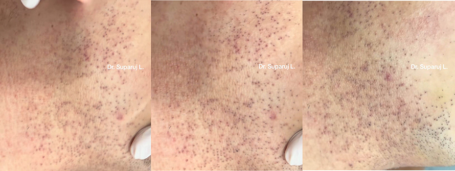 ขนคุดชนิดที่มีรอยแดง Keratosis Pilaris Rubra = KP Rubra มีลักษณะอย่างไร & ดูแลได้อย่างไร ?
