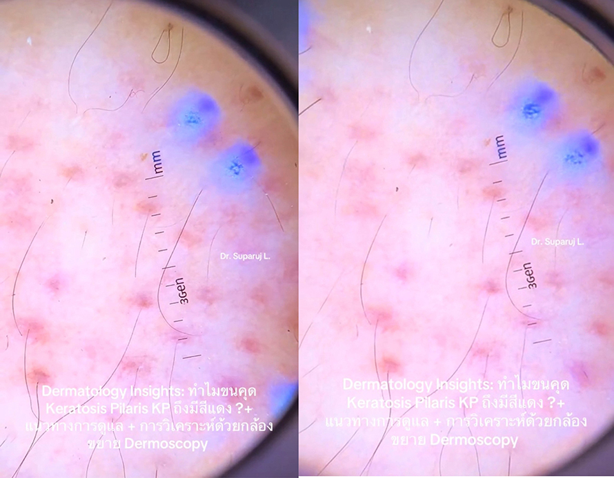 "ทำไมขนคุด Keratosis Pilaris (KP) ถึงมีสีแดง? + แนวทางการดูแล + วิเคราะห์ผิวกล้องส่องขยาย Dermoscopy " วันนี้หมอจะพามาวิเคราะห์ด้วยกล้องขยายผิวหนังหรือ Dermoscopy กันครับ "ทำไมขนคุด Keratosis Pilaris (KP) ถึงมีสีแดง? + แนวทางการดูแล + วิเคราะห์ผิวกล้องส่องขยาย Dermoscopy " วันนี้หมอจะพามาวิเคราะห์ด้วยกล้องขยายผิวหนังหรือ Dermoscopy กันครับ