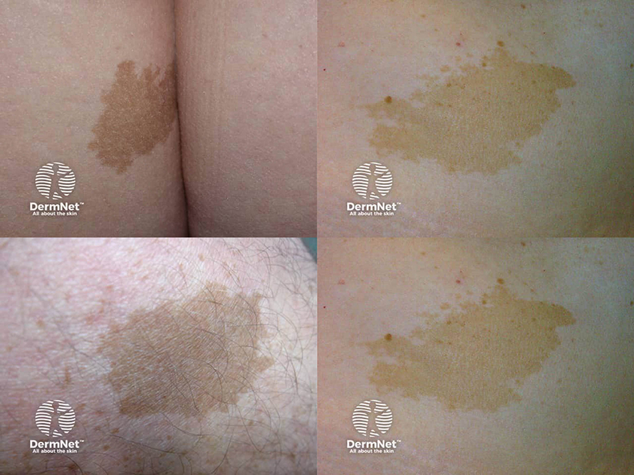 ปานสีน้ำตาล มีลักษณะอย่างไร & ดูแลได้อย่างไร?