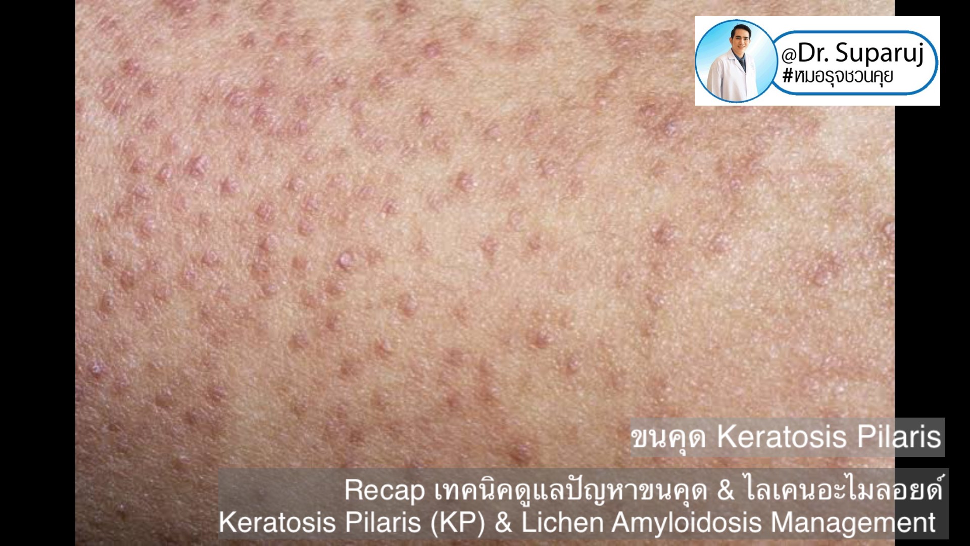 Recap เทคนิคดูแลปัญหาขนคุด & ไลเคนอะไมลอยด์ Keratosis Pilaris (KP) & Lichen Amyloidosis Management