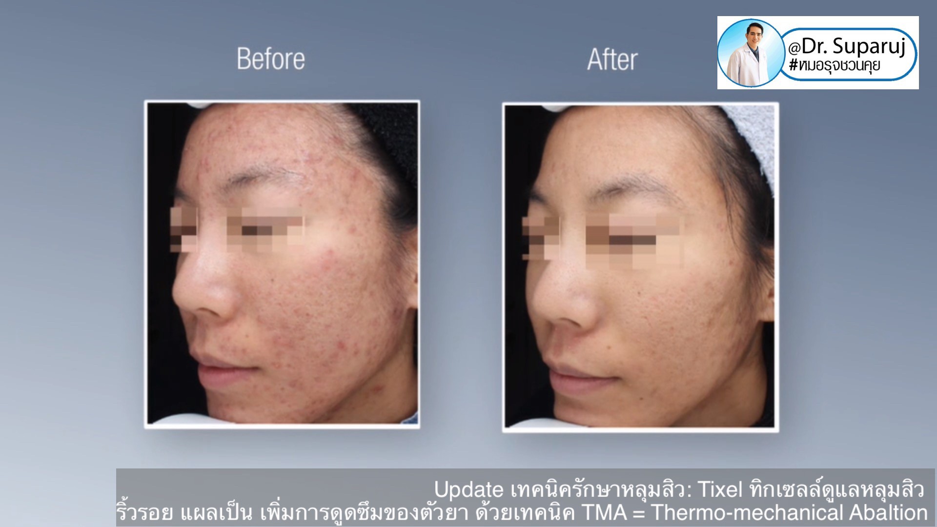 Update เทคนิครักษาหลุมสิว: Tixel ทิ๊กเซลล์ รักษาหลุมสิว ริ้วรอย แผลเป็น เพิ่มการดูดซึมยาด้วยเทคนิค TMA = Thermo-mechanical Abaltion Update เทคนิครักษาหลุมสิว: Tixel ทิ๊กเซลล์ รักษาหลุมสิว ริ้วรอย แผลเป็น เพิ่มการดูดซึมยาด้วยเทคนิค TMA = Thermo-mechanical Abaltion