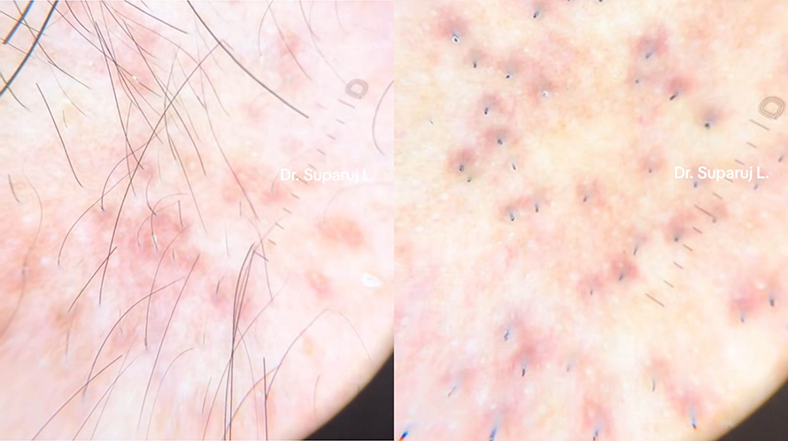 ขนคุดชนิดที่มีรอยแดง Keratosis Pilaris Rubra = KP Rubra มีลักษณะอย่างไร & ดูแลได้อย่างไร ? ขนคุดชนิดที่มีรอยแดง Keratosis Pilaris Rubra = KP Rubra มีลักษณะอย่างไร & ดูแลได้อย่างไร ?