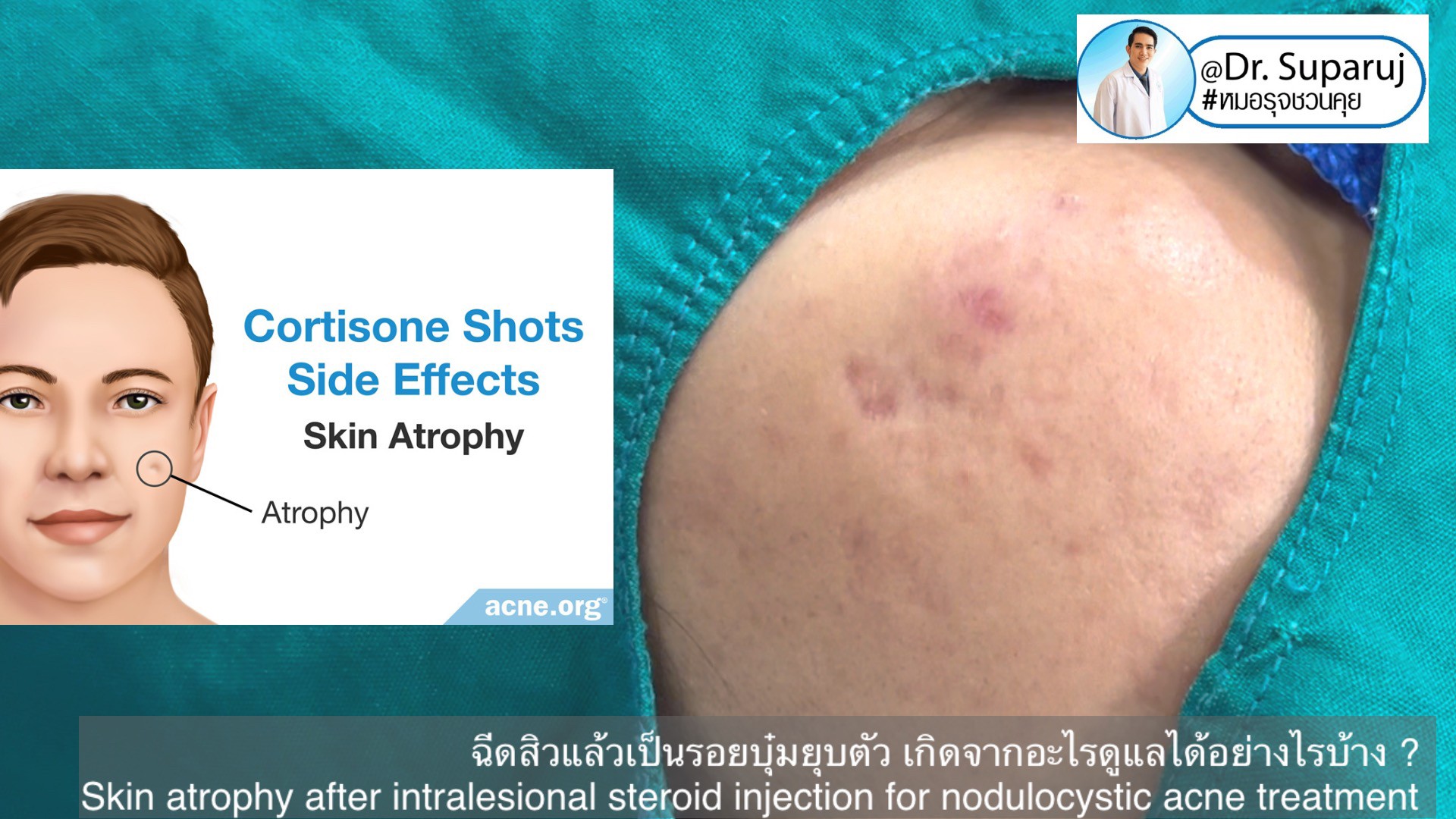 ฉีดสิวแล้วเป็นรอยบุ๋มยุบตัว เกิดจากอะไรดูแลได้อย่างไรบ้าง ?  (Skin atrophy after intralesional steroid injection for nodulocystic acne treatment )