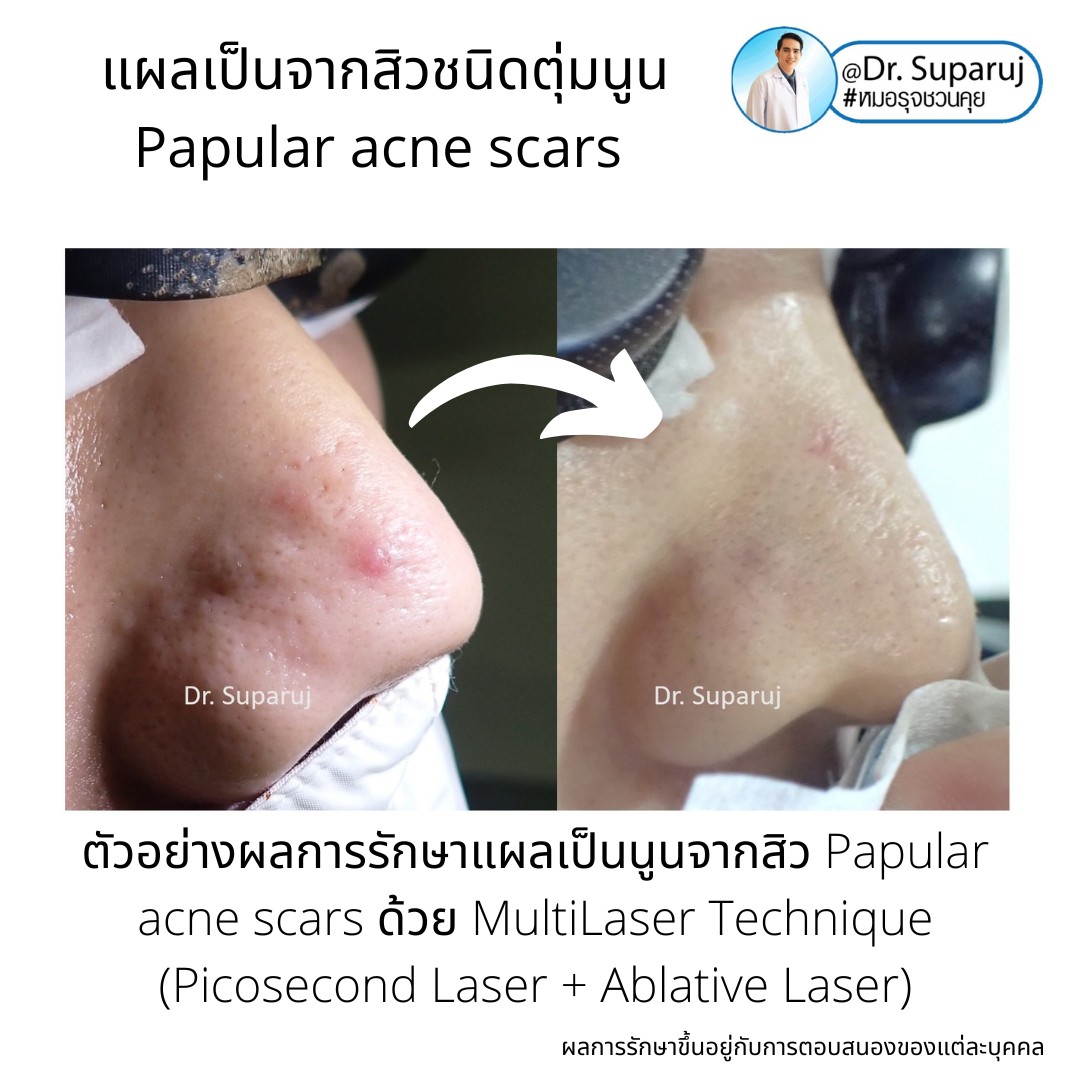 เทคนิคดูแลแผลเป็นตุ่มนูนจากสิว Papular acne scar ที่จมูก + คาง ด้วย Fractional Discovery Picosecond Laser + Deep Focused Ablative Laser