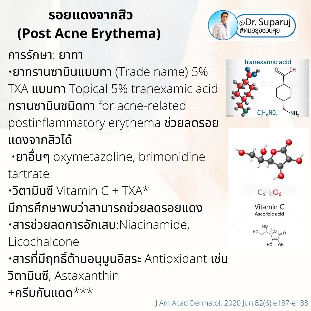 แนะนำเทคนิคดูแลรอยแดงสิว เส้นเลือดฝอย : เทคนิครักษารอยแดงสิว เส้นเลือดฝอย ด้วย Discovery Picosecond Laser PT Microsecond Pulses Mode 