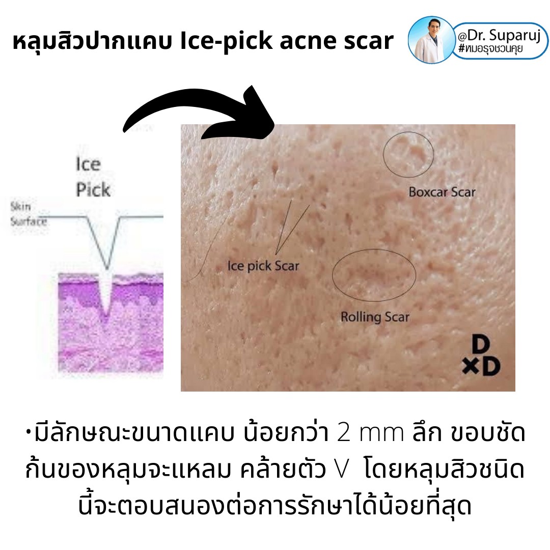  แนะนำเทคนิครักษาหลุมสิวจิกลึก Ice Pick Acne Scar ด้วยเทคนิคเลเซอร์ UltraDeep Pico Technique (Ice Pick Acne Scar Treatment with Discovery Pico Laser + UltraDeep Pico Technique)