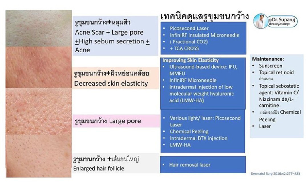 รูขุมขนกว้าง Enlarged Facial Pore เกิดจากอะไร ? + เทคนิคดูแลด้วยโปรแกรม Discovery Pico Laser หลายความยาวคลื่น +หลายพลังงานร่วมกัน รูขุมขนกว้าง Enlarged Facial Pore เกิดจากอะไร ? + เทคนิคดูแลด้วยโปรแกรม Discovery Pico Laser หลายความยาวคลื่น +หลายพลังงานร่วมกัน