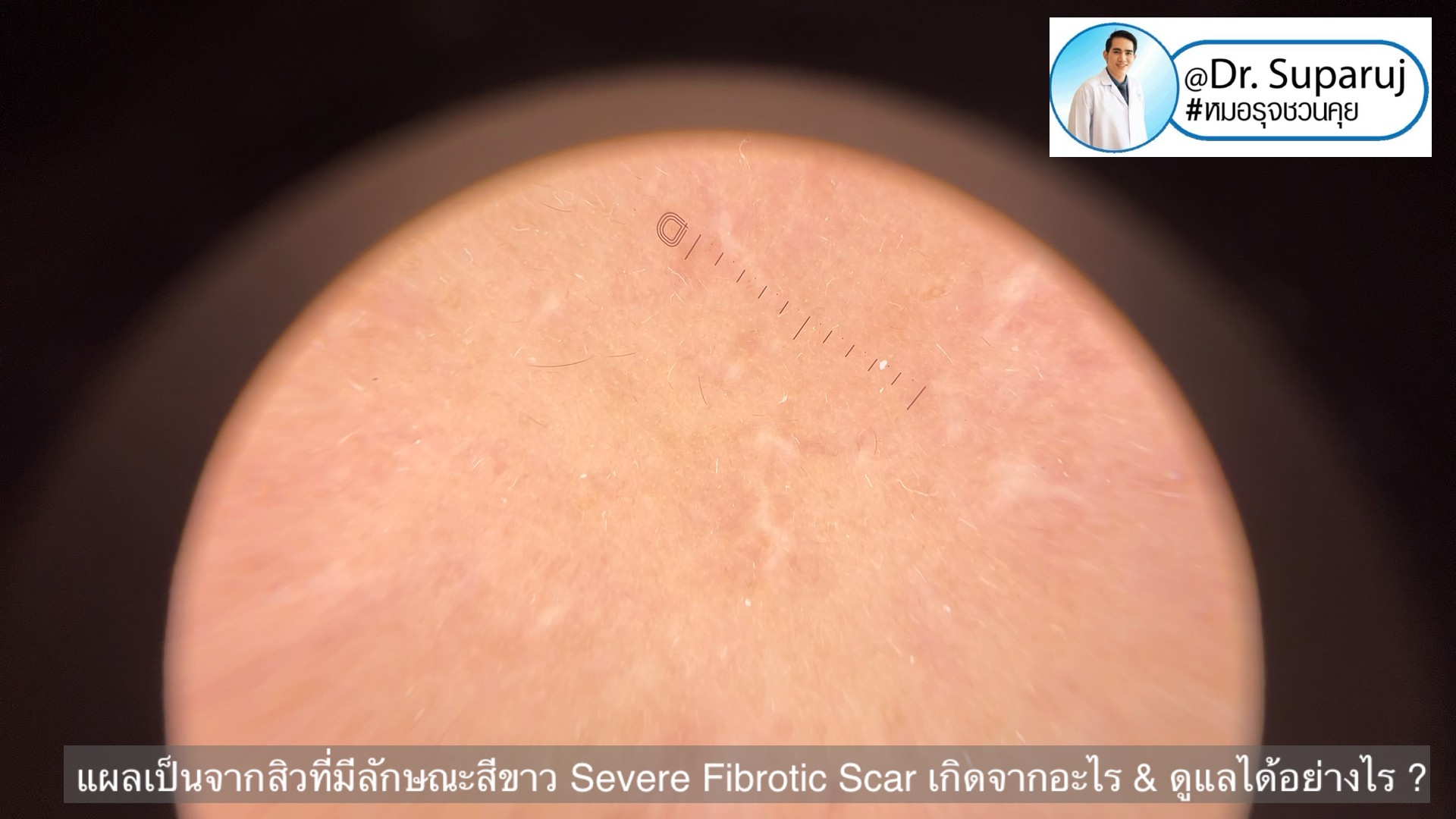 แผลเป็นจากสิวที่มีลักษณะสีขาว severe fibrotic acne scar เกิดจากอะไร & ดูแลได้อย่างไร ?