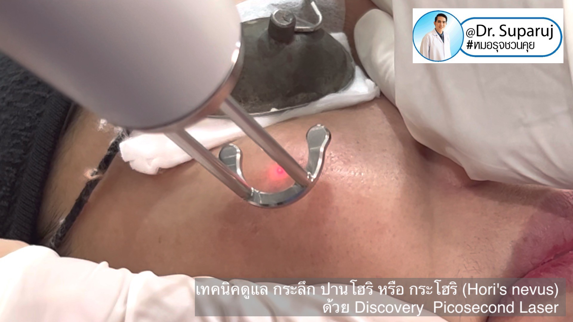 เทคนิครักษากระโฮริ กระลึก ปานโฮริ (Hori's nevus) ด้วยเลเซอร์ Discovery Picosecond Laser เทคนิครักษากระโฮริ กระลึก ปานโฮริ (Hori's nevus) ด้วยเลเซอร์ Discovery Picosecond Laser