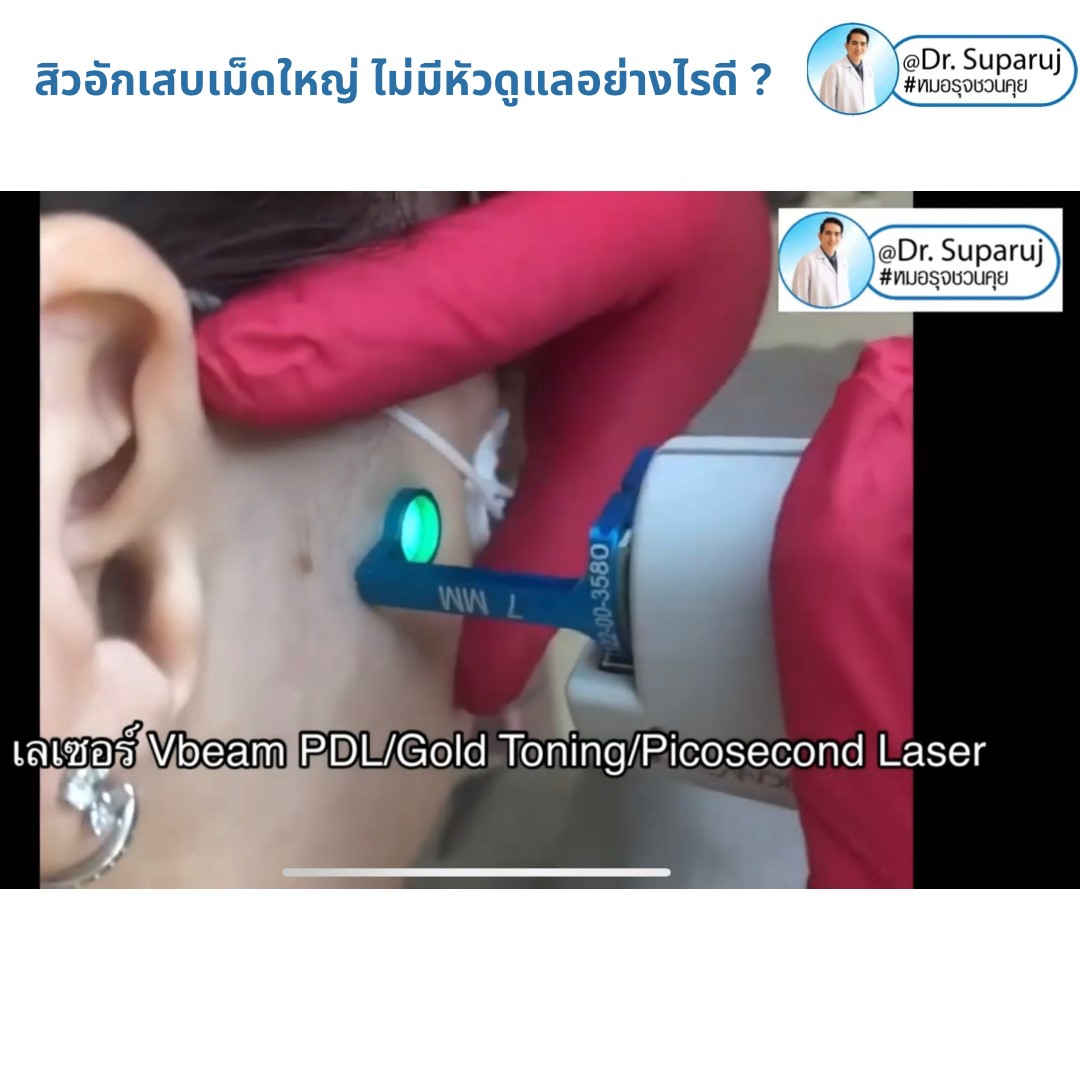 มีสิวอักเสบเม็ดใหญ่ ไม่มีหัว ขึ้น ดูแลอย่างไรดี ? มีสิวอักเสบเม็ดใหญ่ ไม่มีหัว ขึ้น ดูแลอย่างไรดี ?