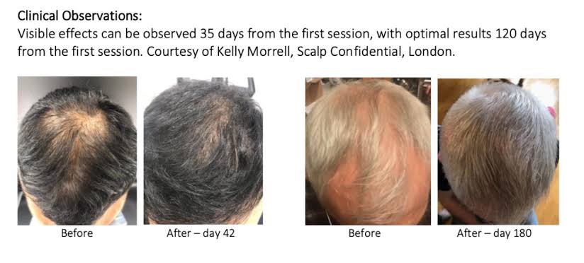 Update จากการประชุมแพทย์ผิวหนังระดับโลก WCD 2023: นวัตกรรมในการดูแลผมร่วงผมบางด้วยการใช้ Calecim Advanced Hair System Update จากการประชุมแพทย์ผิวหนังระดับโลก WCD 2023: นวัตกรรมในการดูแลผมร่วงผมบางด้วยการใช้ Calecim Advanced Hair System