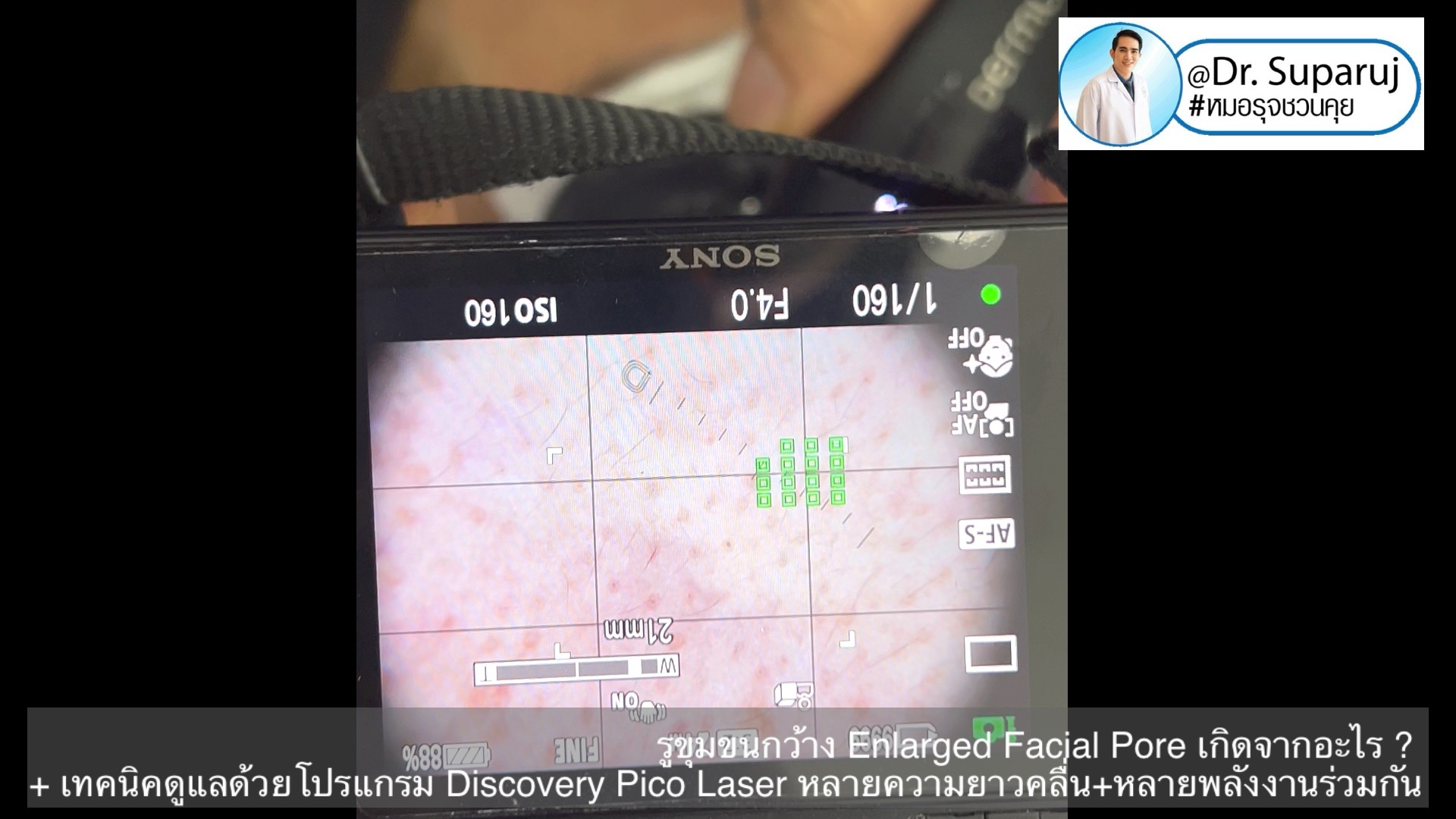 รูขุมขนกว้าง Enlarged Facial Pore เกิดจากอะไร ? + เทคนิคดูแลด้วยโปรแกรม Discovery Pico Laser หลายความยาวคลื่น +หลายพลังงานร่วมกัน รูขุมขนกว้าง Enlarged Facial Pore เกิดจากอะไร ? + เทคนิคดูแลด้วยโปรแกรม Discovery Pico Laser หลายความยาวคลื่น +หลายพลังงานร่วมกัน