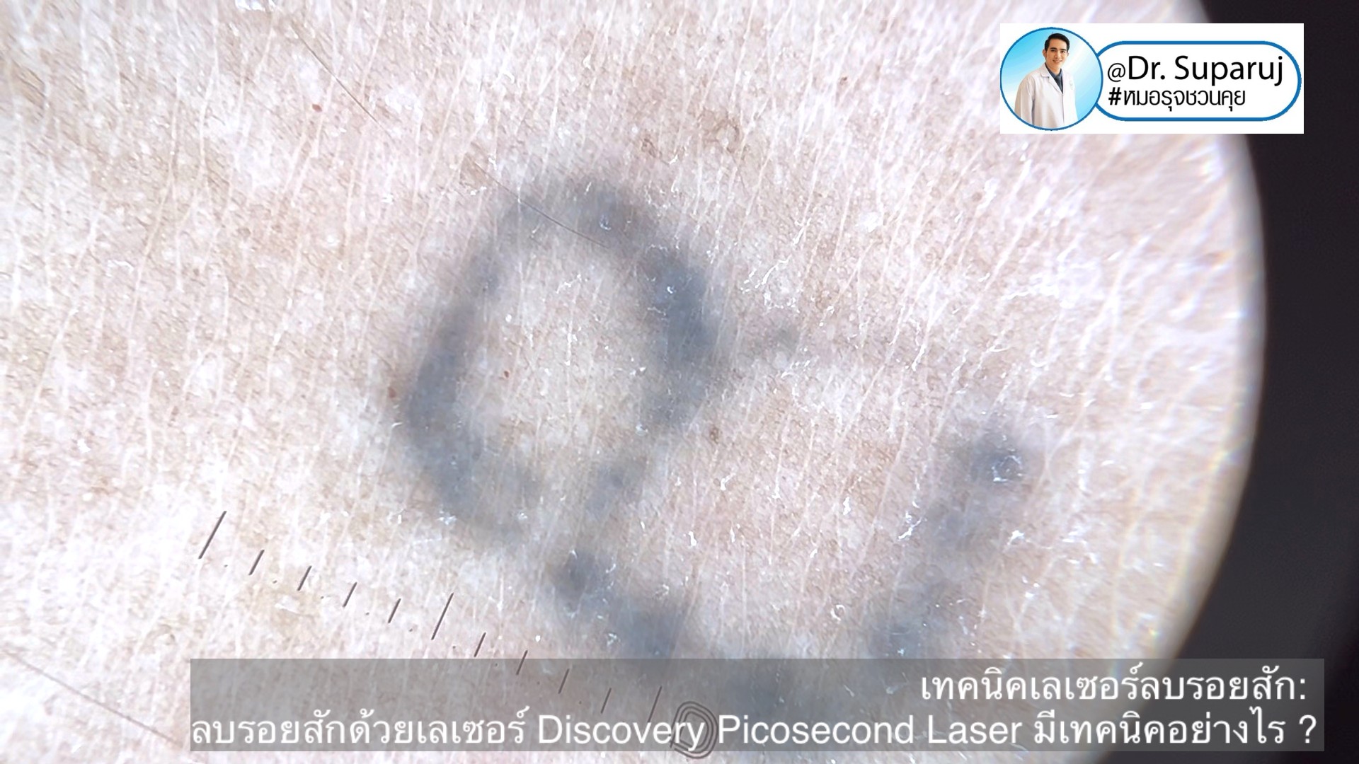 แนะนำเทคนิคเลเซอร์ลบรอยสักด้วย Picosecond Laser: ลบรอยสักด้วยเลเซอร์ Discovery Picosecond Laser มีเทคนิคอย่างไร ? แนะนำเทคนิคเลเซอร์ลบรอยสักด้วย Picosecond Laser: ลบรอยสักด้วยเลเซอร์ Discovery Picosecond Laser มีเทคนิคอย่างไร ?