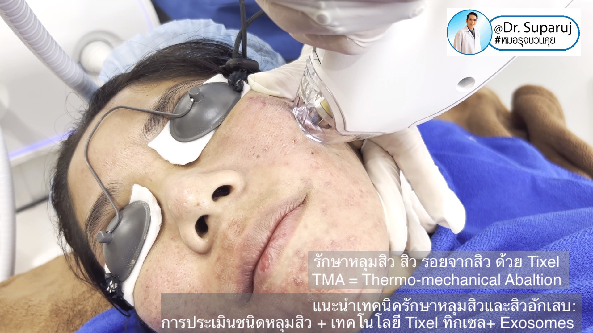 ผลลัพธ์อาจแตกต่างกันไป แล้วแต่บุคคล ผลลัพธ์อาจแตกต่างกันไป แล้วแต่บุคคล