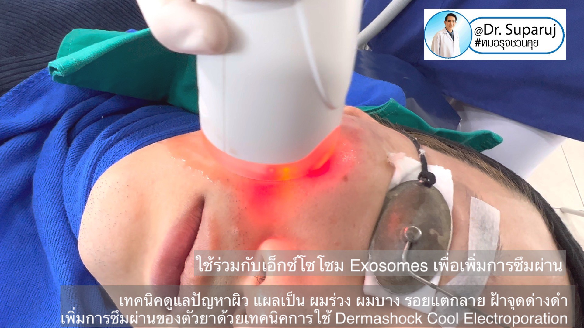 เทคนิคดูแลปัญหาผิว แผลเป็น ผมร่วง ผมบาง รอยแตกลาย ฝ้าจุดด่างดำ เพิ่มการซึมผ่านของตัวยาด้วยเทคนิคการใช้ Dermashock Cool Electroporation เทคนิคดูแลปัญหาผิว แผลเป็น ผมร่วง ผมบาง รอยแตกลาย ฝ้าจุดด่างดำ เพิ่มการซึมผ่านของตัวยาด้วยเทคนิคการใช้ Dermashock Cool Electroporation