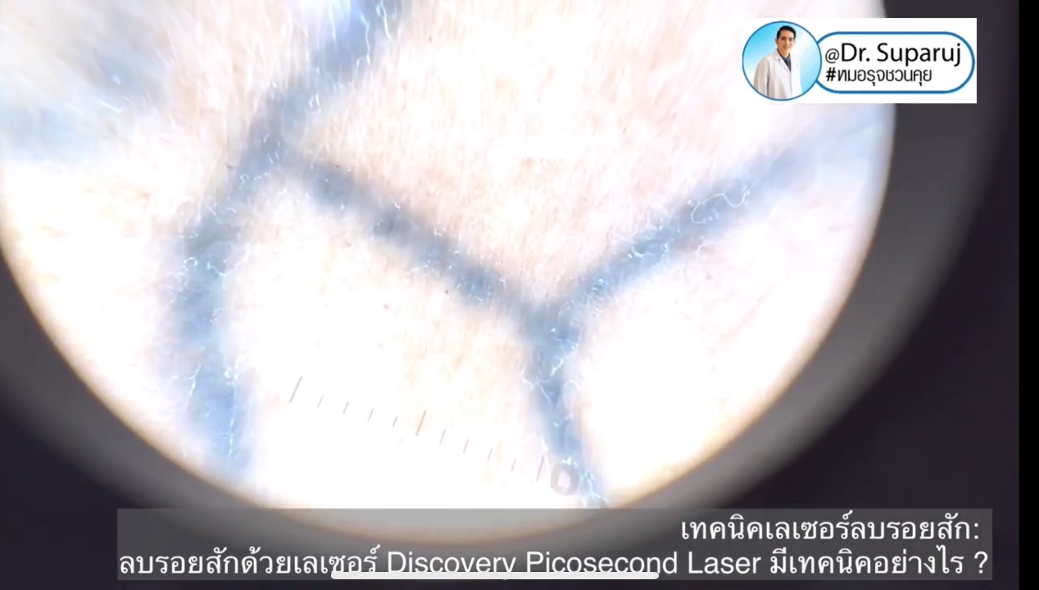ทำไมต้องลบรอยสักด้วย พิโค่เลเซอร์ Picosecond Laser ทำไมต้องลบรอยสักด้วย พิโค่เลเซอร์ Picosecond Laser