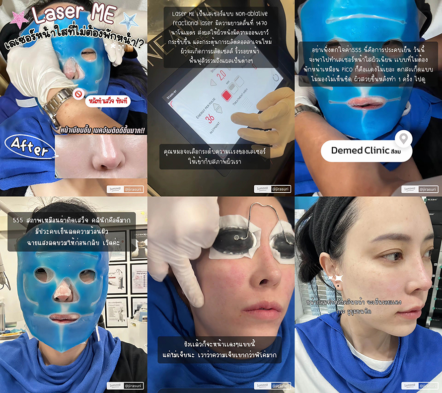 ขอบคุณคุณจูน @jirasuri มากนะครับที่ไว้วางใจให้หมอได้ดูแลปัญหาเรื่องรูขุมขนและจุดด่างดำด้วย โปรแกรม LaserME ครับผม ขอบคุณคุณจูน @jirasuri มากนะครับที่ไว้วางใจให้หมอได้ดูแลปัญหาเรื่องรูขุมขนและจุดด่างดำด้วย โปรแกรม LaserME ครับผม