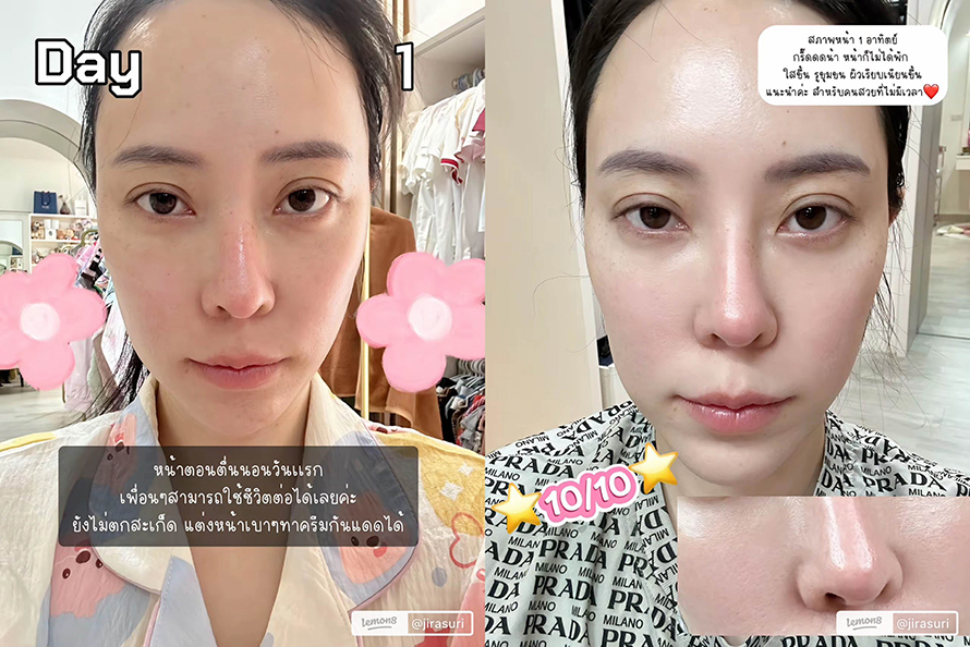 ขอบคุณคุณจูน @jirasuri มากนะครับที่ไว้วางใจให้หมอได้ดูแลปัญหาเรื่องรูขุมขนและจุดด่างดำด้วย โปรแกรม LaserME ครับผม