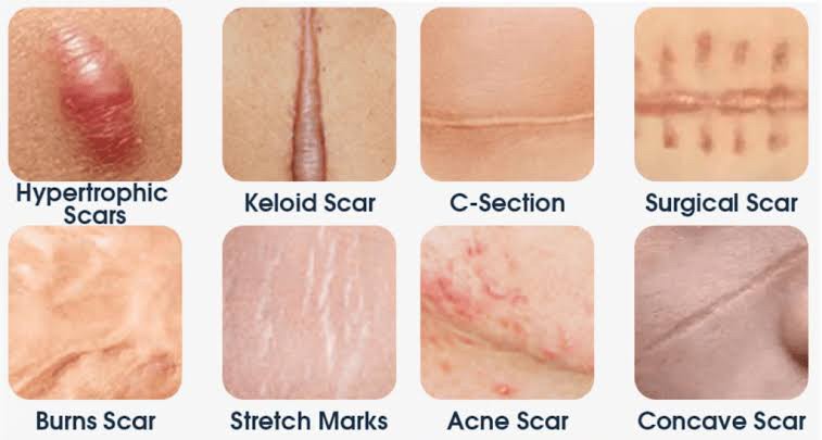 Recap เทคนิครักษาแผลเป็น แผลเป็นนูน คีลอยด์ แผลผ่าตัด Scar Treatment Recap เทคนิครักษาแผลเป็น แผลเป็นนูน คีลอยด์ แผลผ่าตัด Scar Treatment