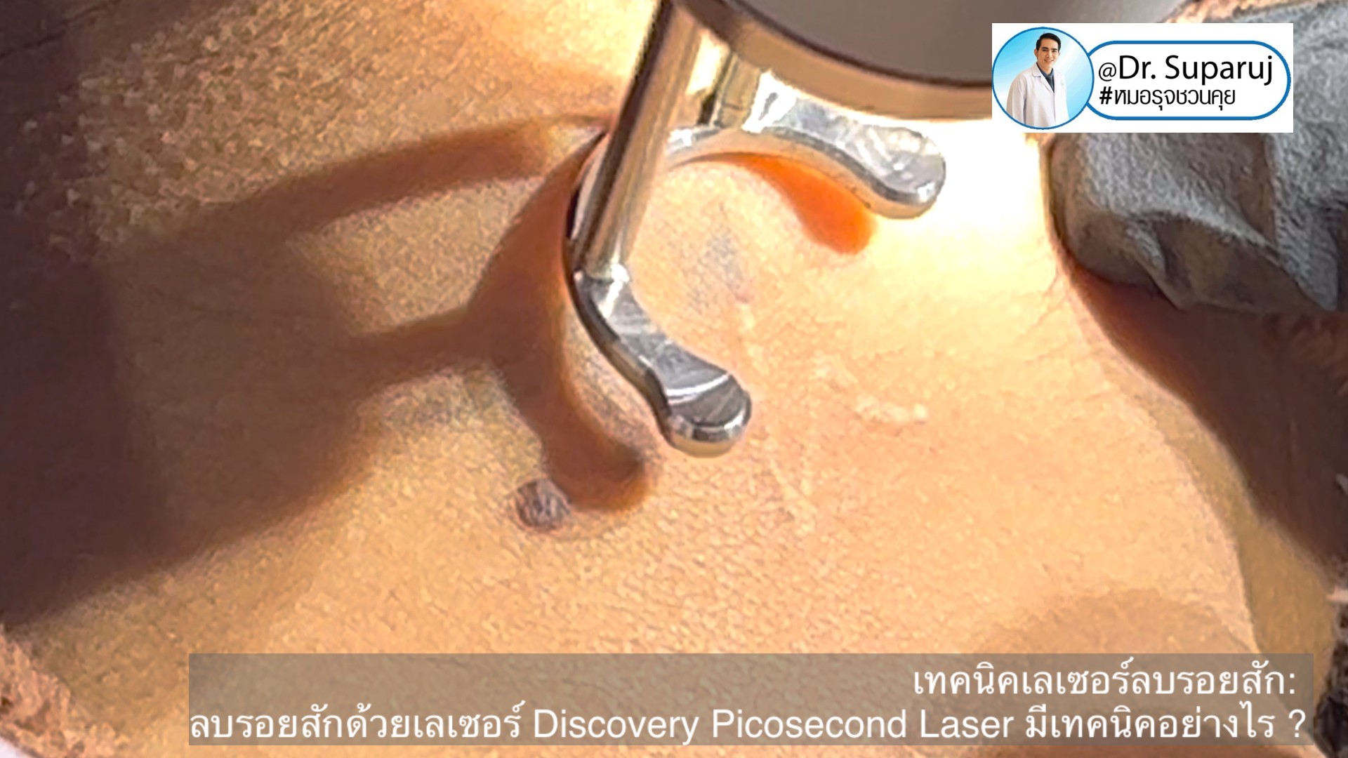 แนะนำเทคนิคเลเซอร์ลบรอยสักด้วย Picosecond Laser: ลบรอยสักด้วยเลเซอร์ Discovery Picosecond Laser มีเทคนิคอย่างไร ? แนะนำเทคนิคเลเซอร์ลบรอยสักด้วย Picosecond Laser: ลบรอยสักด้วยเลเซอร์ Discovery Picosecond Laser มีเทคนิคอย่างไร ?