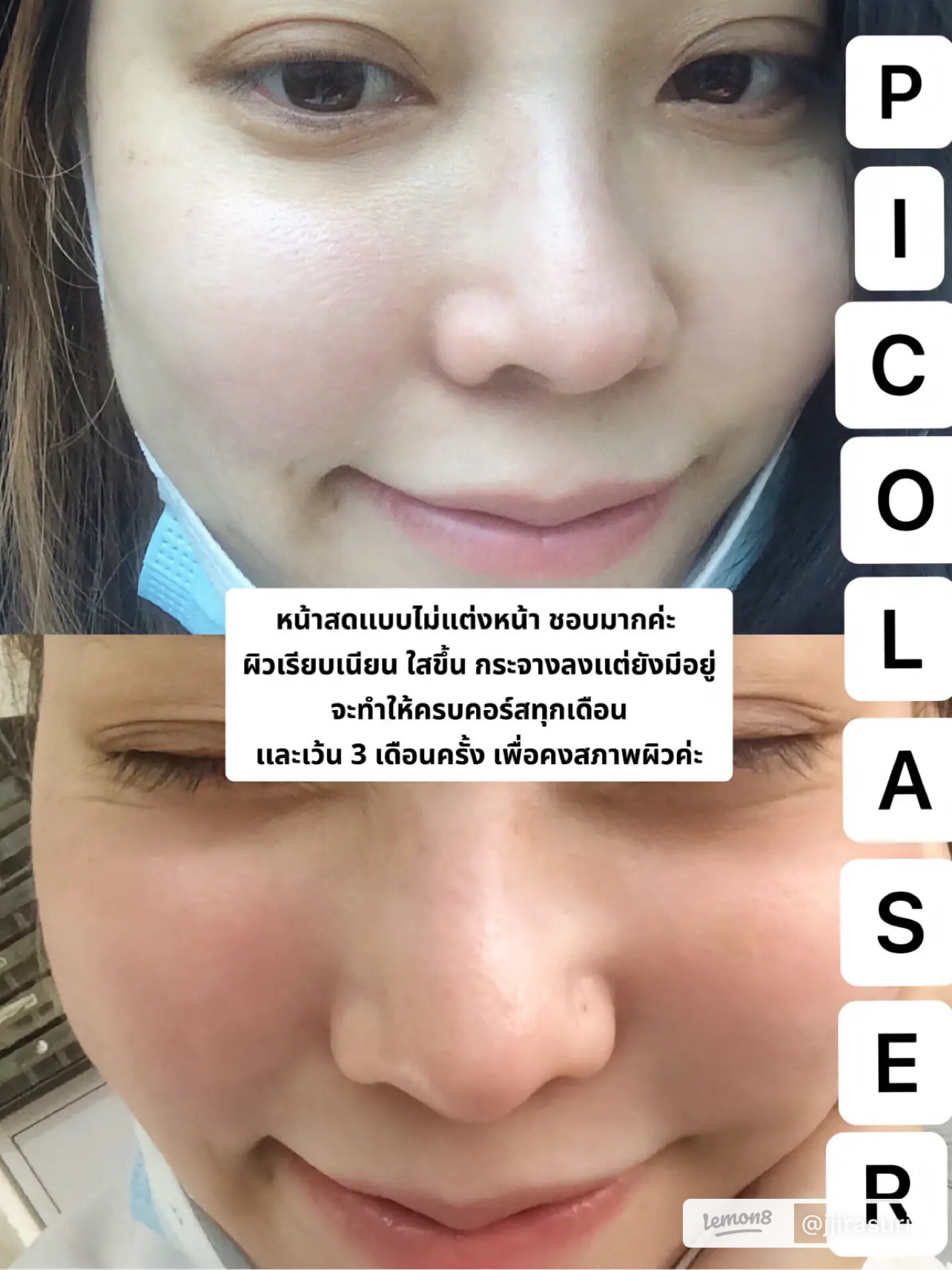 แนะนำเทคนิคดูแลรูขุมขนกว้าง: เทคนิคดูแลรูขุมขนกว้างด้วย Deep Carbon Peel Picosecond Laser (เทคนิคการใช้ Picosecond Laser พิโค่เลเซอร์ ร่วมกับผง carbon กระตุ้นการสร้างคอลลาเจนดูแลรูขุมขนกว้าง ) แนะนำเทคนิคดูแลรูขุมขนกว้าง: เทคนิคดูแลรูขุมขนกว้างด้วย Deep Carbon Peel Picosecond Laser (เทคนิคการใช้ Picosecond Laser พิโค่เลเซอร์ ร่วมกับผง carbon กระตุ้นการสร้างคอลลาเจนดูแลรูขุมขนกว้าง )