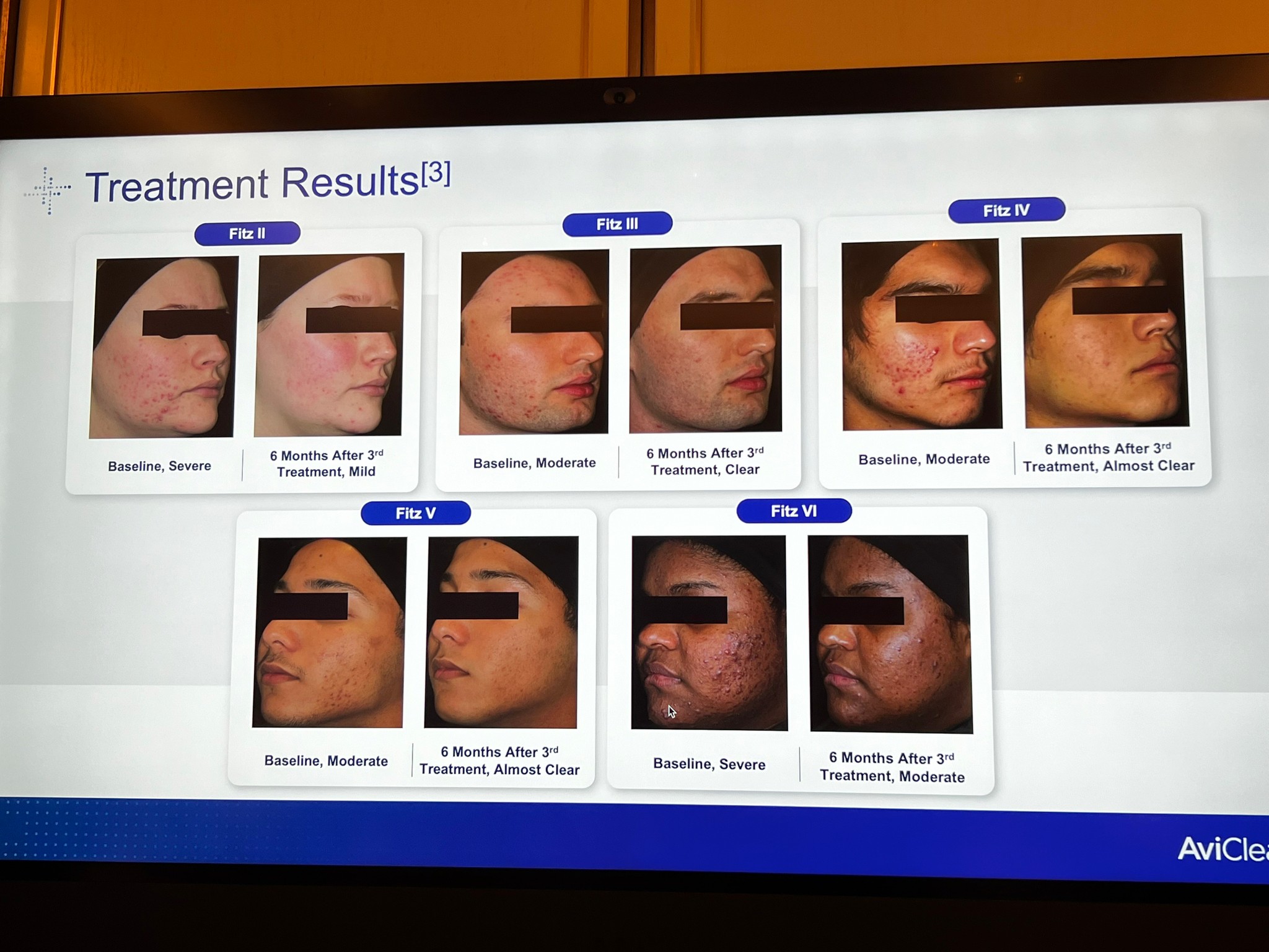 Update เครื่องเลเซอร์สำหรับรักษาสิวโดยเฉพาะ จับกับต่อมไขมันโดยตรง = AviClear 1726 nm Laser Update เครื่องเลเซอร์สำหรับรักษาสิวโดยเฉพาะ จับกับต่อมไขมันโดยตรง = AviClear 1726 nm Laser