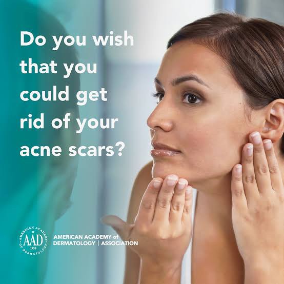 เป็นหลุมสิว แต่ยังไม่พร้อมรักษาหลุมสิว ทำอย่างไรดี? (+ เทคนิคการ เลือกใช้วิธีรักษาลุมสิวเบื้องต้นครับ) เป็นหลุมสิว แต่ยังไม่พร้อมรักษาหลุมสิว ทำอย่างไรดี? (+ เทคนิคการ เลือกใช้วิธีรักษาลุมสิวเบื้องต้นครับ)