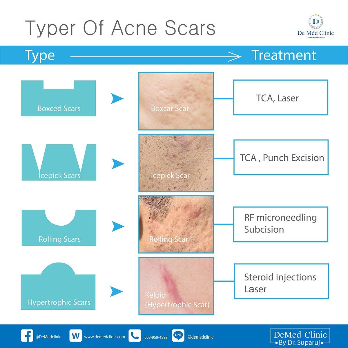 Update เทคนิครักษาหลุมสิว: หลุมสิวแบบจิกลึก Ice Pick Acne Scar มีลักษณะ & ดูแลได้อย่างไร ?