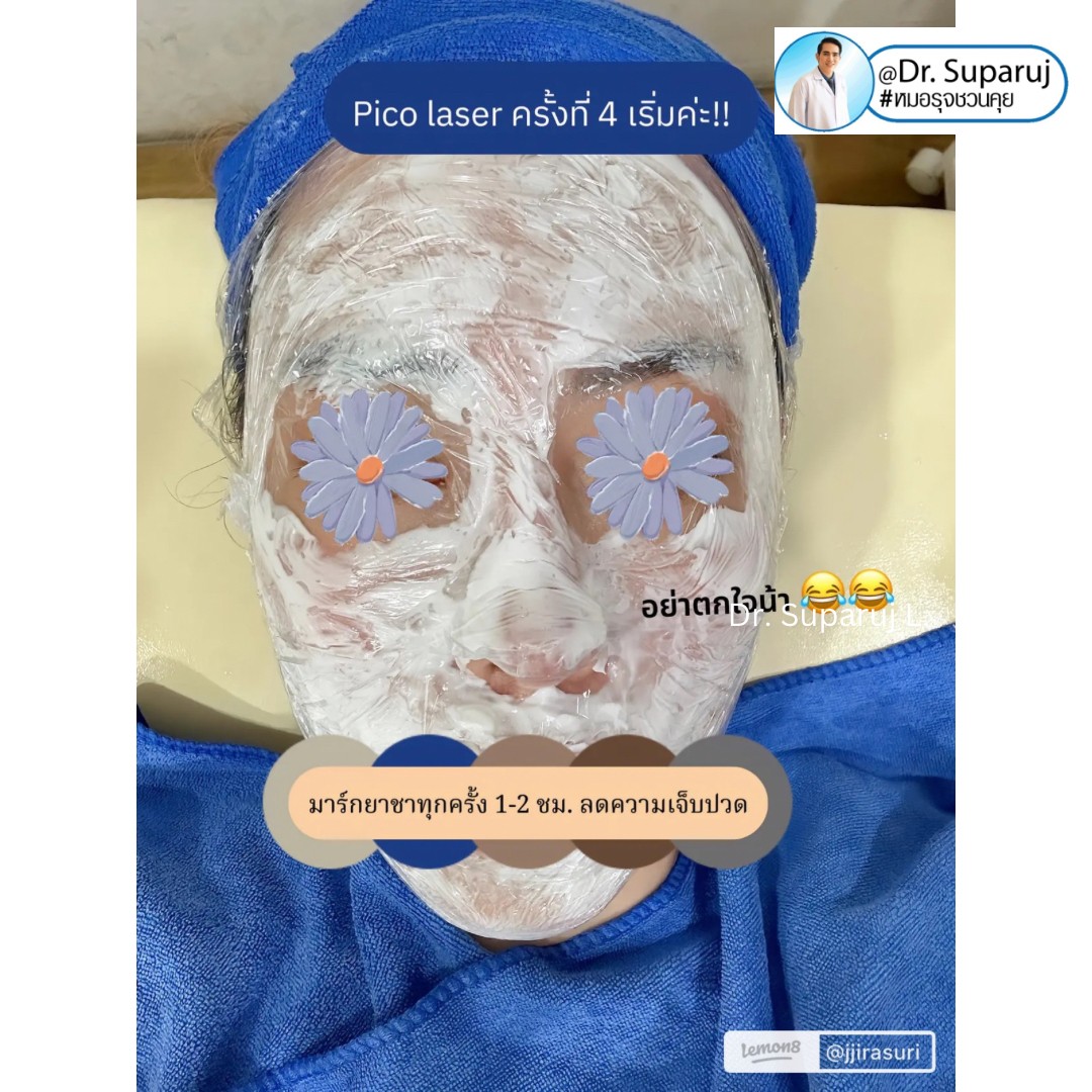 รีวิวรักษาหลุมสิวด้วย Pico Laser +Exosome มันเริดมากแม๊ รีวิวรักษาหลุมสิวด้วย Pico Laser +Exosome มันเริดมากแม๊